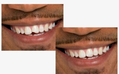 Dental Bonding vs. Veneers: Which Is Right for You?