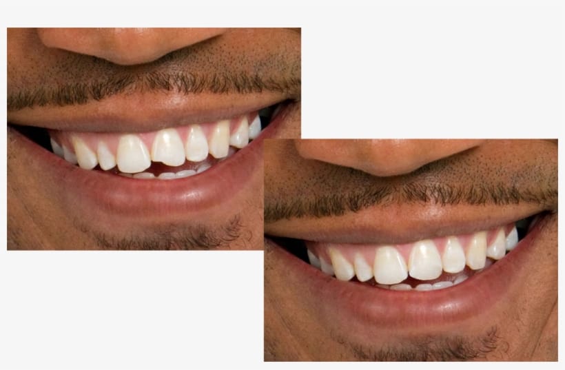 Dental Bonding vs. Veneers